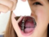 綾子ちゃんの歯★★お得な動画＆画像セット★★インレー脱離後、1年放置！立派なクラウン娘